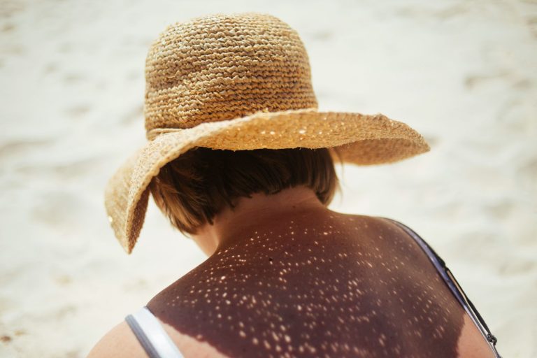 Donna di spalle sulla spiaggia con grande cappello di paglia per evitare le scottature del cuoio capelluto